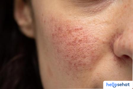 Atasi Rosacea Secara Alami: Panduan Lengkap Kulit Sehat Berseri