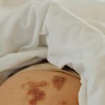 Bercak Kopi Susu pada Anak? Waspadai Neurofibromatosis Tipe 1 (NF1)!
