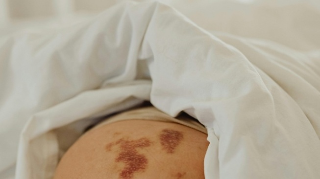 Bercak Kopi Susu pada Anak? Waspadai Neurofibromatosis Tipe 1 (NF1)!