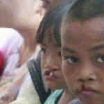Bibir Sumbing pada Anak: Operasi & Terapi Dini, Kunci Masa Depan Cerah