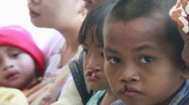 Bibir Sumbing pada Anak: Operasi & Terapi Dini, Kunci Masa Depan Cerah