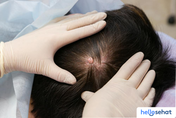 Hilangkan Kista Pilar: Panduan Lengkap Penyembuhan Alami & Medis