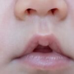 Perjuangan Panjang Sembuh dari Bibir Sumbing: Kisah Inspiratif Indonesia