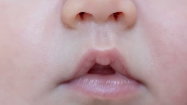 Perjuangan Panjang Sembuh dari Bibir Sumbing: Kisah Inspiratif Indonesia