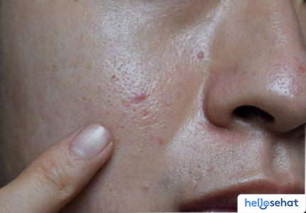 Rahasia Kulit Glowing: Atasi Sel Kulit Mati Sekarang!