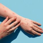 Waspada Mpox: Gejala, Pencegahan, dan Informasi Terbaru