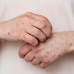 Waspada! Mpox Merebak, WHO Perpanjang Status Darurat Global