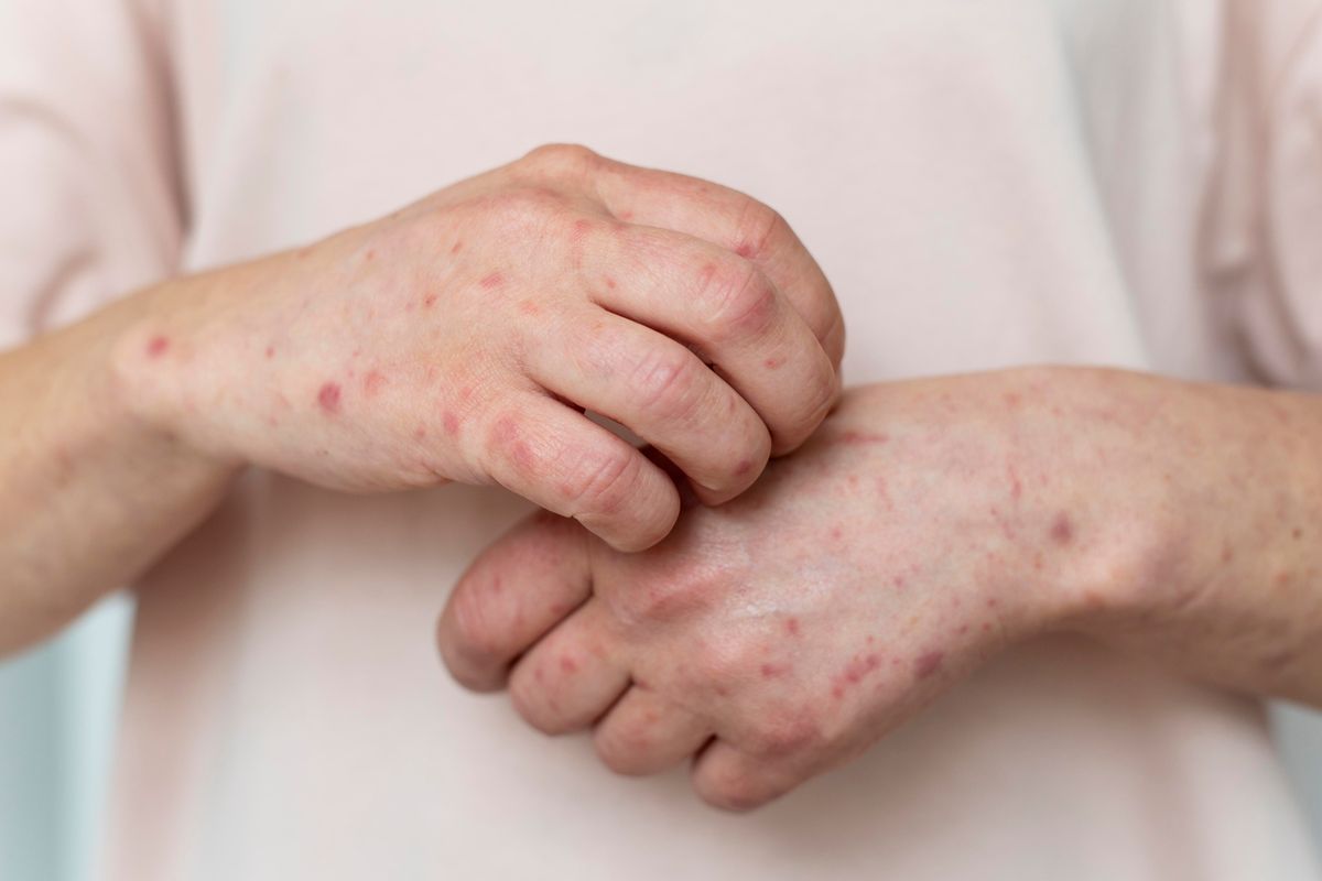 Waspada! Mpox Merebak, WHO Perpanjang Status Darurat Global