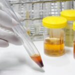 Waspadai Warna Urine: Tanda Awal Penyakit Ginjal Kronis?